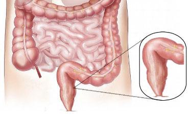 Ulcerative Colitis/ Crohn’s Disease - Dr. Chintamani Godbole, Colorectal Surgeon in Mumbai