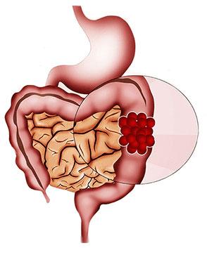 Colorectal Surgeon in Mumbai