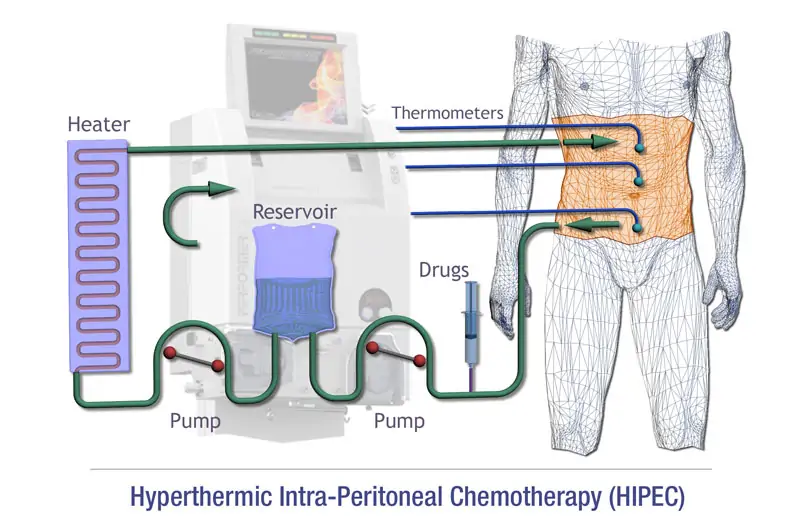HIPEC Anal Fissure Treatment in Dadar, Mumbai