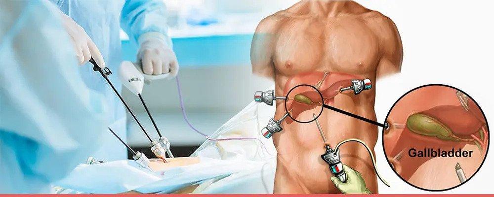 Laparoscopic Cholecystectomy surgery in mumbai