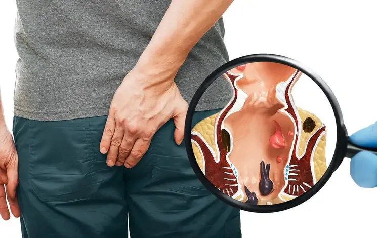 piles treatment in mumbai