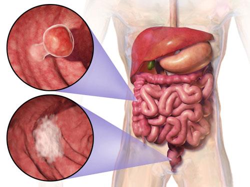 Colon Treatment in Navi Mumbai