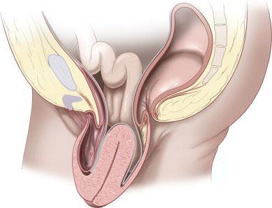 Pelvic Floor Diseases