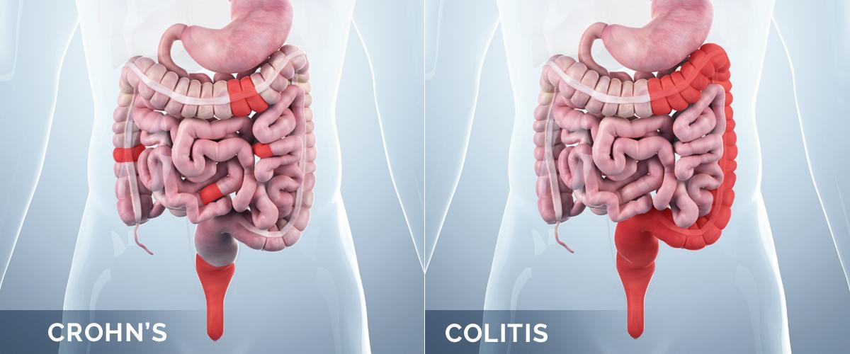 Ulcerative Colitis Crohn's Disease