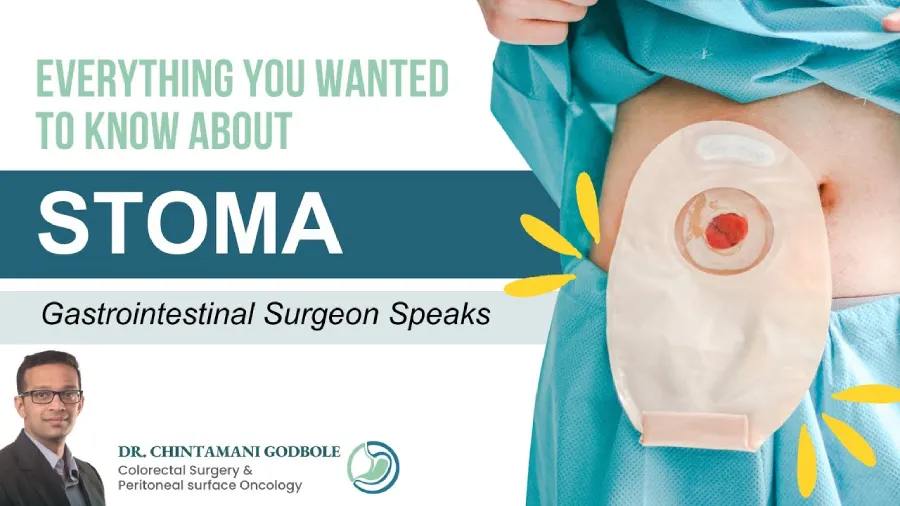 What is Stoma? How to Take Care of Stoma Bag