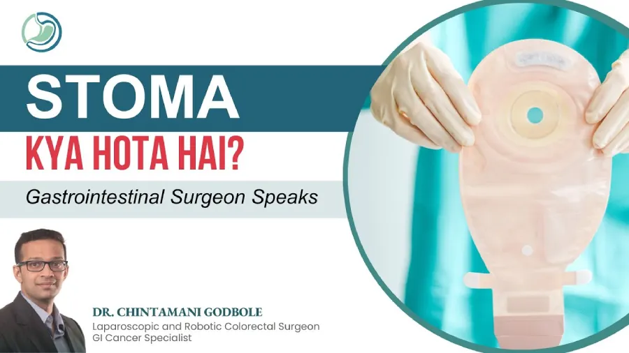 Stoma Bag Kya hai? Colostomy in Hindi | Stoma Care