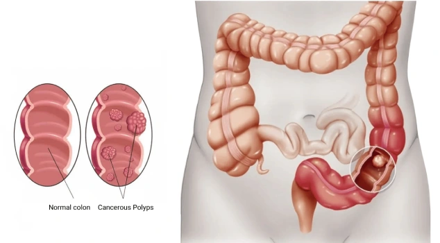 colon cancer treatment in india