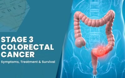 Stage 3 Colorectal Cancer: Symptoms, Treatment, and Survival in India