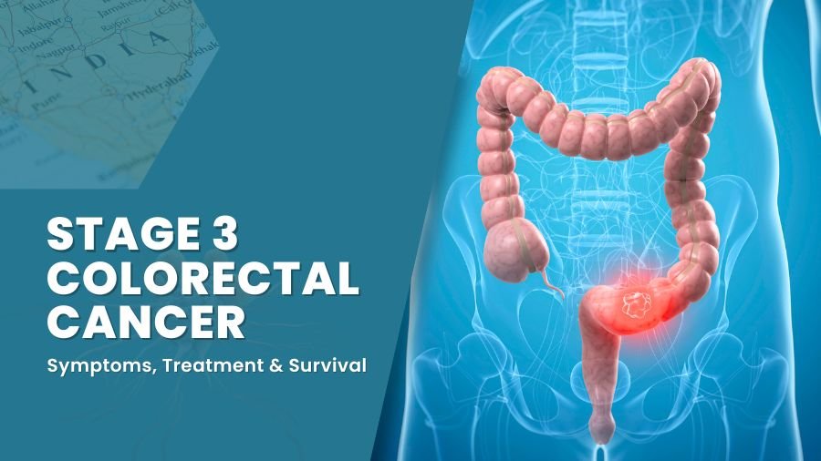 Stage 3 Colorectal Cancer