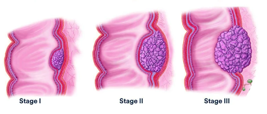 colon cancer stage 3